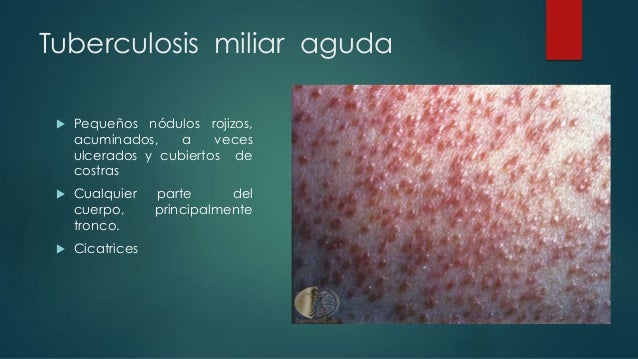 tuberculosis cutanea